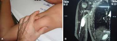 Revista Brasileira De Ortopedia Retrospective Analysis Of 20 Patients Affected By Schwannomas In The Upper And Lower Limbs