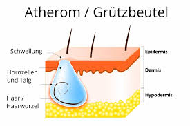 Atherom Grutzbeutel Ursachen Symptome Behandlung