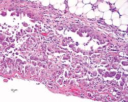 Problems In Mesothelioma Diagnosis Addis 2009 Histopathology Wiley Online Library