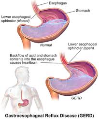When stomach acid makes its way back into the esophagus, it can cause an intense burning. Gastroesophageal Reflux Disease Physiopedia
