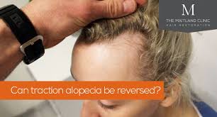Image result for Alopecia