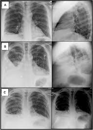 Most effusions start like this and can be easily missed. A 37 Year Old Man With Pleuritic Chest Pain Chest