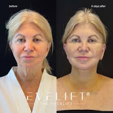 I feel like I'm 40 again!” 💙 Meet Lyn*, 67-years-young from Sarasota.  These photos were taken just 6 days after her EVELift® — and the  transformation speaks for itself. “You definitely are
