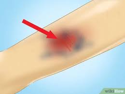 How to use graze in a sentence. How To Treat A Graze 14 Steps With Pictures Wikihow