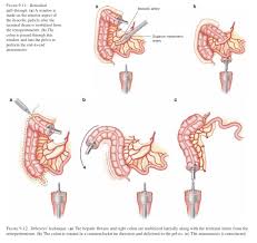 Colon cleansing, also known as colon therapy, or colon hydrotherapy, or a colonic, or colonic irrigation encompasses a number of alternative medical therapies claimed to remove unspecified toxins from the colon and intestinal tract by removing supposed accumulations of feces. Cirbosque Some4surgery On Twitter Deloyers Technique For Right Colo Rectal Anastomosis Step By Step Some4surgery Medtwitter Juliomayol Swexner Pferrada1 Misirg1 Almagoch Salo75 Jmills1955 Drthawaba Https T Co 1b7la06zdk