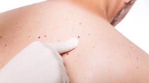 Learn more about these partnerships and how you too can join us in our mission to save lives, celebrate lives, and lead the fight for a world without cancer. This Man S Skin Tag Turned Out To Be Skin Cancer Allure