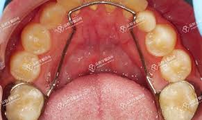 兒童牙齒矯正- 品粹牙醫
