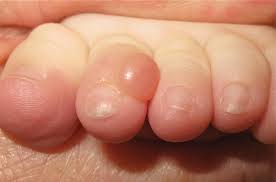 Bladder changes such as pain when passing. Nodule On The Second Toe In An Infant Mdedge Dermatology
