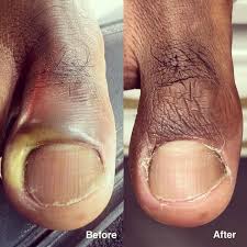 Image result for Paronychia feet