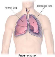 What is it?a pneumothorax is commonly known as a collapsed lung. Media Springernature Com Lw685 Springer Static
