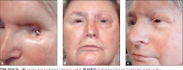 Figure 1 from Prosthetic eye rehabilitation and management of completely  blind patients.