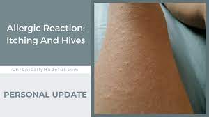 Allergic Reaction Itching And Hives