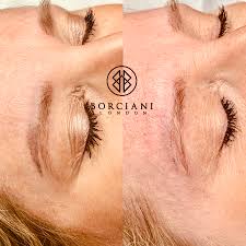 Removery tattoo removal & fading has updated their hours and services. Permanent Makeup Removal London Borciani London