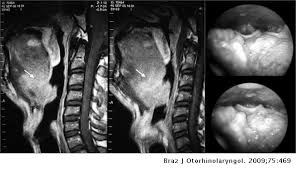 Hypertrophy of lingual tonsils can be safely and effectively managed by transoral robotic surgery via a minimally invasive approach. Lingual Tonsil Pseudolymphoma And Obstructive Sleep Apnea Brazilian Journal Of Otorhinolaryngology