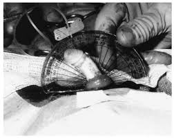 Image result for Chordee