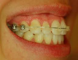 The Hybrid Resin Material Provides Better Sliding Mechanics Than Stainless Steel At A Relatively Comparable Shear Stre Clear Braces Orthodontics Resin Material