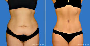 Best Doctor For Tummy Tuck Surgery In Dwarka Tummy Tuck Surgery Tummy Tucks Liposuction
