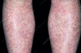 Image result for allergy rash on the legs