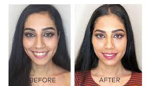 Nationally renowned gummy smile specialist explains what you need to know about lip repositioning surgery and how it affects confidence. Gummy Smile Correction And Lip Enhancement Youtube