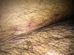 An ingrown hair is a hair that grows into the skin, rather than straight out of the hair follicle. I Have Extreme Ingrown Hairs On My Pubic Area Would Laser Treatment Be Best Photos