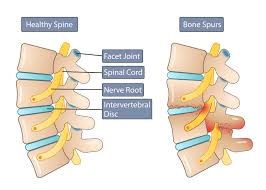 We did not find results for: Bone Spurs Symptoms Causes What Is A Bone Spur Mnc