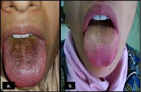 Image result for brown tongue symptoms