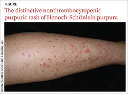 Immune thrombocytopenic purpura (itp) immune thrombocytopaenic purpura (itp) involves the development of a purpuric rash in those with low circulating platelets (<100 x 10⁹/l) in the absence of any clear cause. 8 Year Old Boy Palpable Purpura On The Legs With Arthralgia Absence Of Coagulopathy Upper Respiratory Infection Dx Mdedge Family Medicine