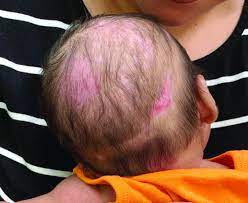 If itchiness causes a person to scratch or pick at their scalp, damage to the hair folliclescan occur. A 2 Month Old Infant With A Scalp Rash That Appeared After Birth Mdedge Pediatrics