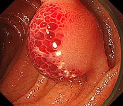 Image result for Small Intestinal Bleeding