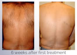 After the first treatment or appointment, it takes around ten to twelve days for the follicles to entirely die. Laser Hair Removal Bothell Wa Medspa Dr Robert Dragotti Tao Cosmetics