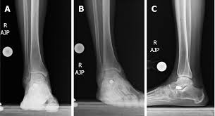 Muscles, and joints working together to perform movements. Distraction Arthroplasty In Osteoarthritis Of The Foot And Ankle