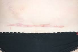 Photo à propos plan rapproché de ventre de femme avec une cicatrice d'une césarienne. Douleur Apres Les Sections Cesariennes Hoov Endore Apres Cesarienne Quand Il Est Normal Et Quand Cela Necessite T Il Un Traitement Comment Soulager La Douleur Suture Apres Les Sections Cesariennes