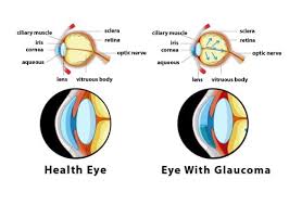Glaucoma is a group of eye conditions that damage the optic nerve, the health of which is vital for good vision. Glaucoma Eye Pressure Symptoms And Treatment Elan Tour