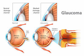 This pressure injures the optic nerve. Glaucoma Causes And Risk Factors