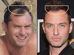 Jude Law Hair Transplant