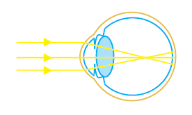 Astigmatisma adalah cacat mata ketika cahaya yang masuk ke mata tidak berpusat dengan sempurna karena cahaya tidak dapat melengkung pada daerah selaput bening. Rumus Kekuatan Lensa Cembung Dan Cekung Idschool