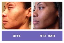 Bio Oil Before And After Black Face Pin On Rodan Fields Before Afters
