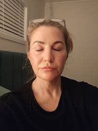 Has anyone had a SMAS neck lift? Here is my before, top left, and now three  weeks out. It's going right back where it was. Doc says skin will tighten  over the