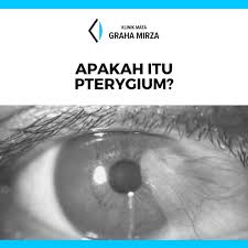 Klinik mata graha mirza telah membantu ribuan pasien khususnya penderita katarak pada mata untuk dapat melihat kembali dengan. Klinikmatagrahamirza Home Facebook