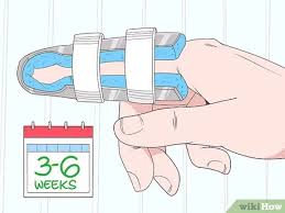 Apply ice to your dislocated finger to reduce swelling. Easy Ways To Fix A Dislocated Finger 12 Steps With Pictures