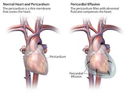 2 symptoms and diagnosis of pericarditis. Your Pericardium Cardiac Health