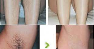 Before And After Laser Hair Removal 6 Sessions Average Diode Laser Hair Removal Laser Hair Removal Unwanted Hair Removal