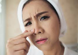 Kulit Mengelupas Di Area Hidung Yuk Atasi Dengan Cara Ini Dermeva