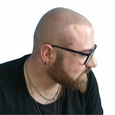 La micropigmentazione capelli deve quindi essere eseguita in. Tricopigmentazione Per Capelli Chiari Tricomedica