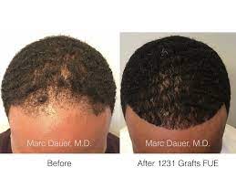 Best hair transplant procedure for black people: Fue Hair Transplant In African American Patient Marc Dauer Md Hair Transplant Doctor Los Angeles