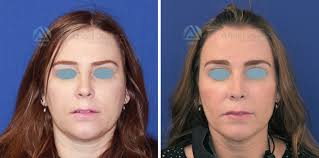 Las incisiones realizadas durante la cirugía de cachete no dejan marca visible en el rostro. Bichectomia Doctor Angel Juarez Cirujano Plastico