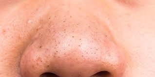Use apple cider vinegar to get rid of whiteheads. Ask Dr Pimple Popper How To Treat Blackheads Women S Health