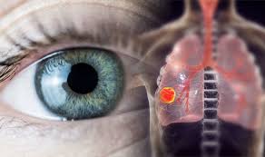 Pancoast tumors can also affect the nerves to your eyes and part of your face. Lung Cancer Symptoms Yellowing Of The Whites Of The Eyes Can Signal The Deadly Disease Express Co Uk