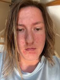 Can someone give some tips of some relief with the itching