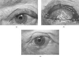 Image result for Eyelid Closure Defect